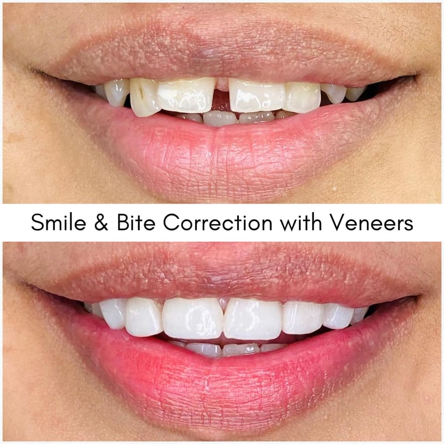 Smile & Bite Correction with Veneers, smile makeover case at i-Smile Dental Clinic