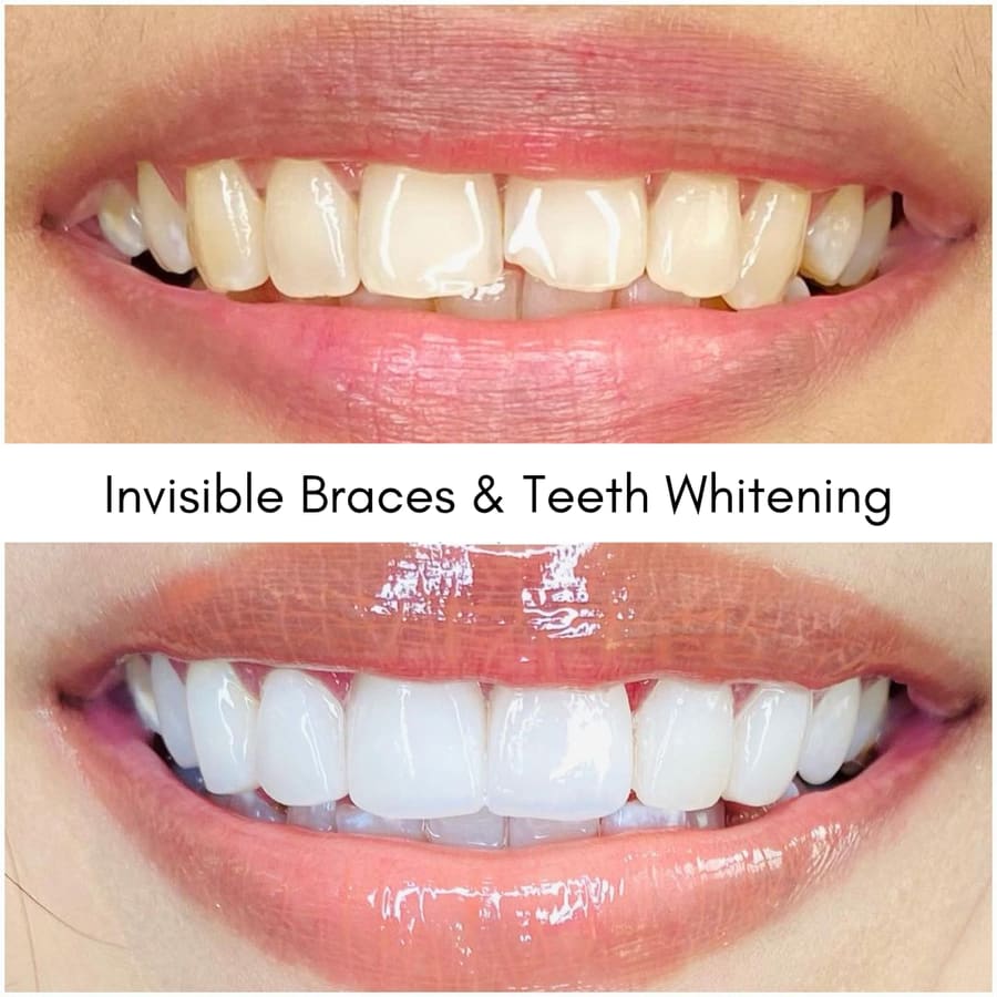 Invisible Braces & Teeth Whitening, smile makeover case at i-Smile Dental Clinic