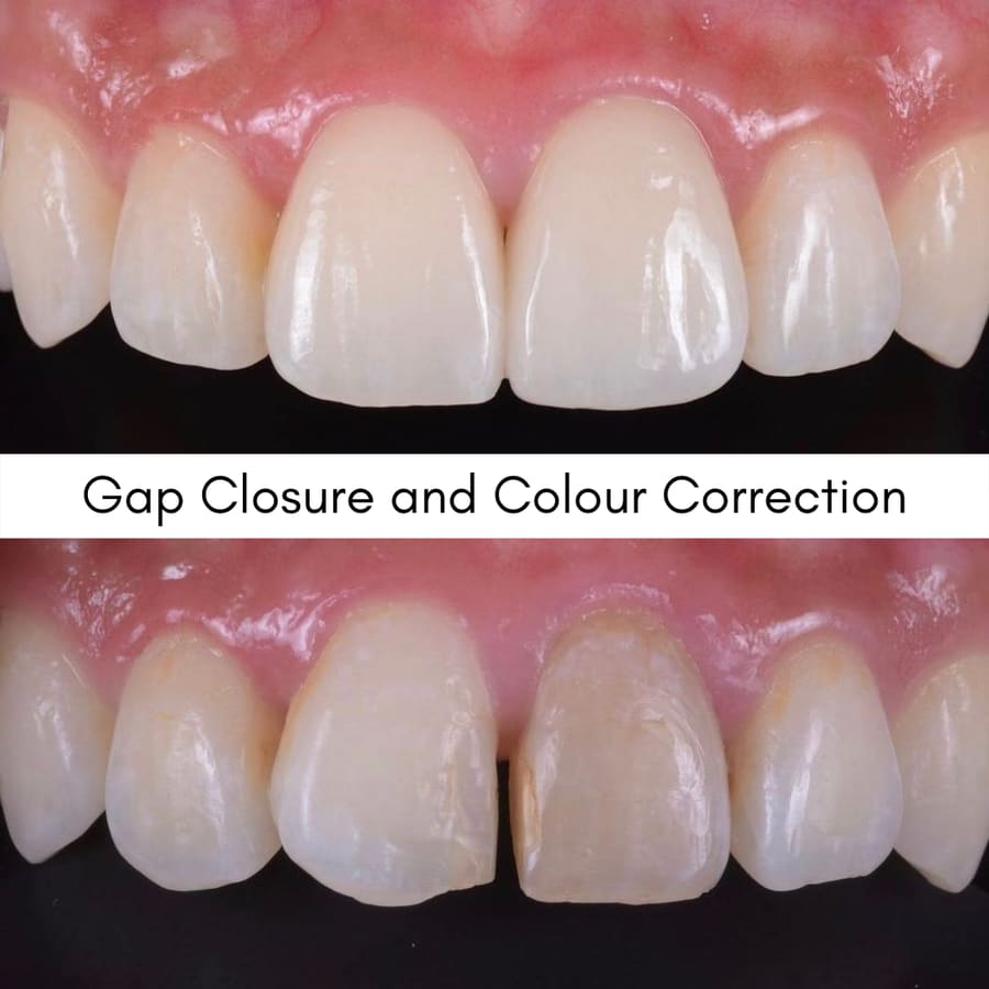 Gap Closure and Colour Correction, smile makeover case at i-Smile Dental Clinic