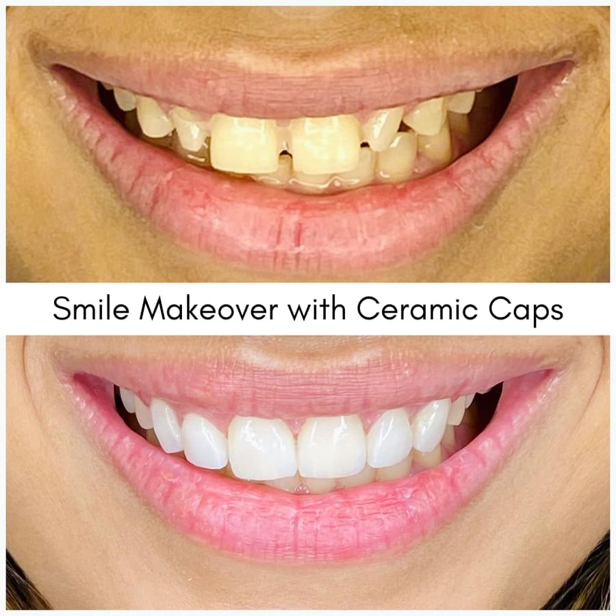 Smile Makeover with Ceramic Caps, smile makeover case at i-Smile Dental Clinic